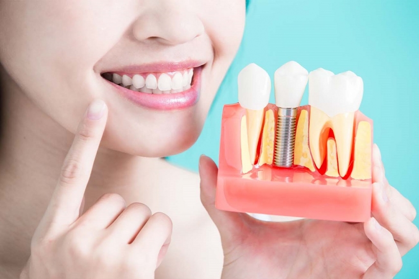 All-on-4 Dental Implants Cost